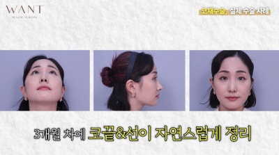 코재수술 몇 번까지 가능할까? 반복수술 위험성과 흉살, 실제 회복 경과 후기! 사진 5