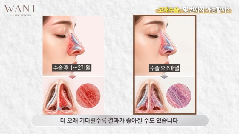 코재수술 몇 번까지 가능할까? 반복수술 위험성과 흉살, 실제 회복 경과 후기! 사진 10