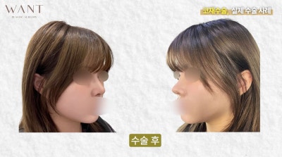 코재수술 몇 번까지 가능할까? 반복수술 위험성과 흉살, 실제 회복 경과 후기! 사진 7